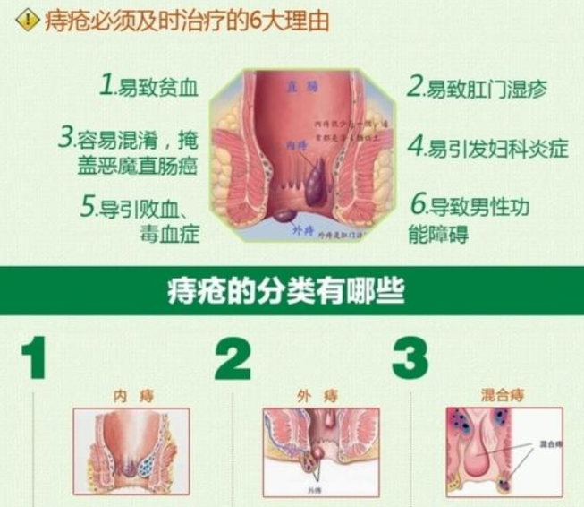 痔疮是什么样子的? 