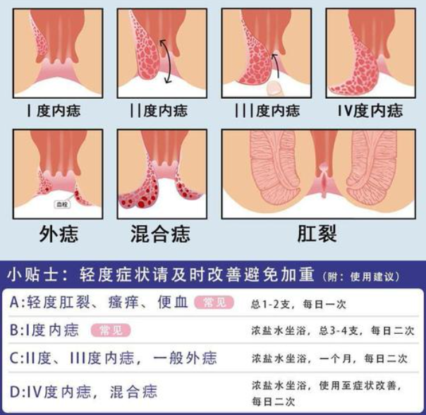 痔疮大便出血怎么办