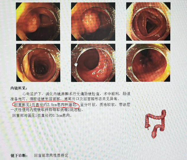 普通肠镜和无痛肠镜有什么区别?