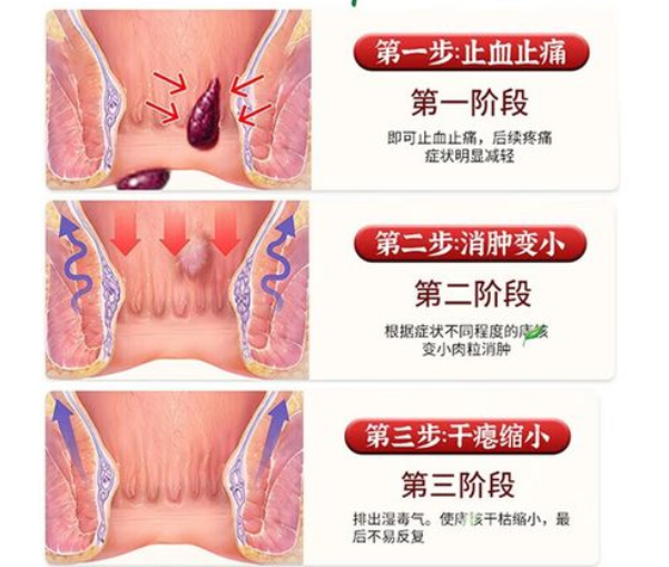 痔疮用什么药治zui好效果zui快
