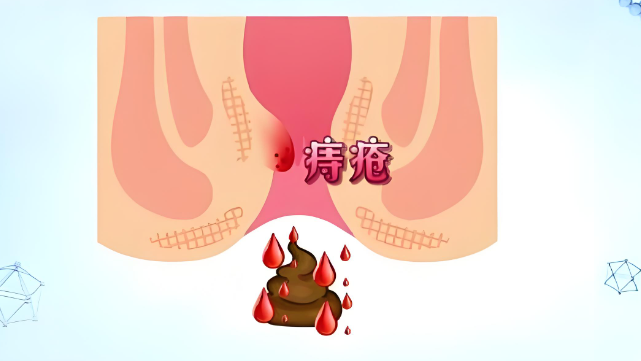 上大便阴道出血是怎么回事