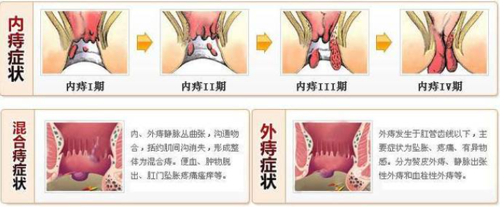 准备痔疮手术时医生说不能做手术怎么回事? 