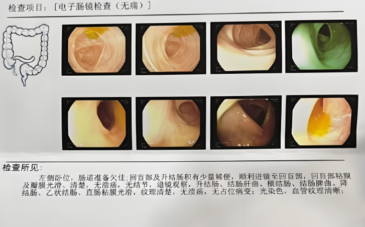 做好无痛肠镜多久可以正常吃饭