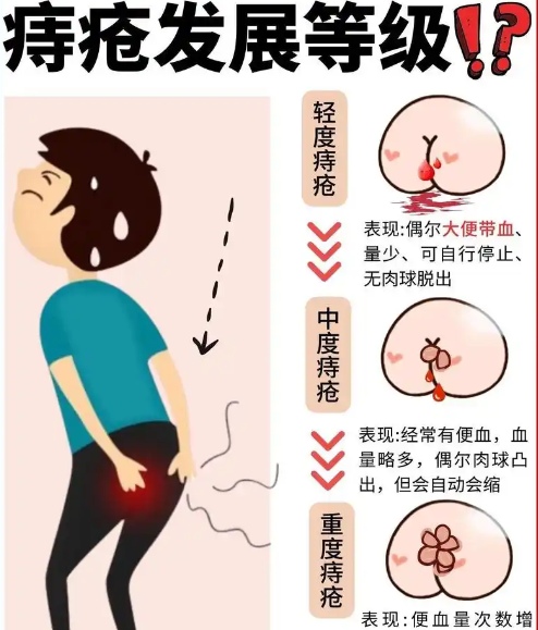 怎么判断自己得了痔疮