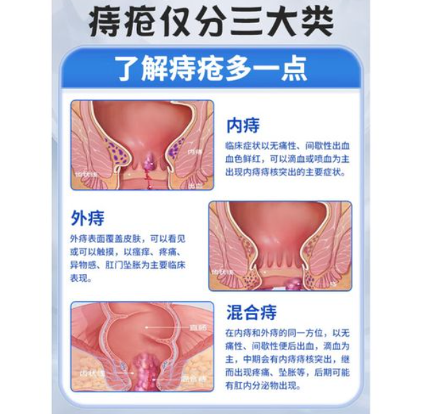 上海痔疮手术需要多少钱？上海能做痔疮手术医院有哪些家
