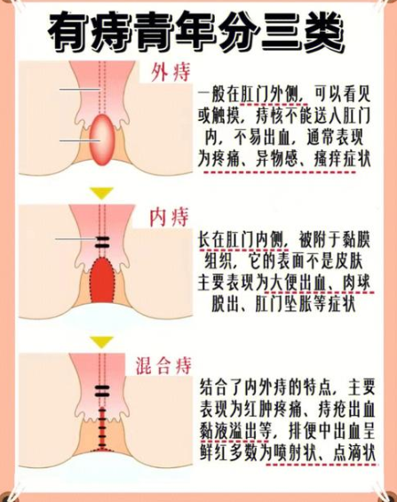 痔疮出血怎么办？该如何治疗