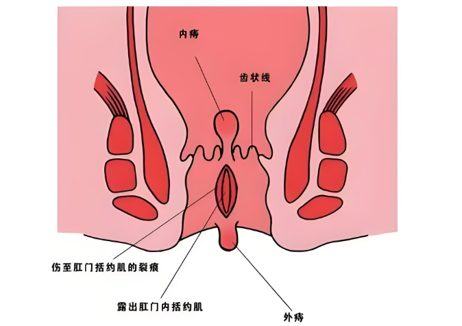 哪些人需要做肛裂手术