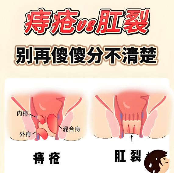 肛裂后屁眼有什么影响