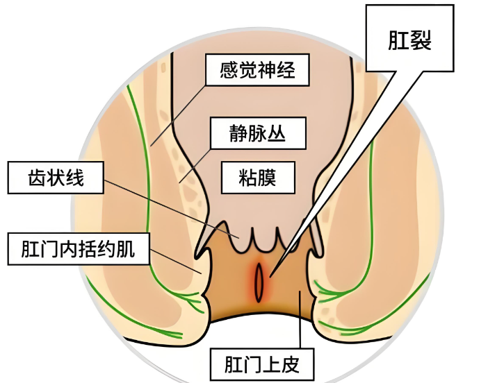 肛裂的常见治疗方法有哪些