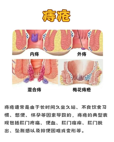 痔疮的症状有些什么