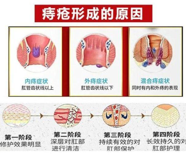 痔疮是怎么引起的