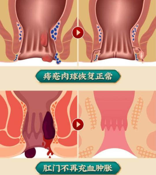 痔疮会传染吗