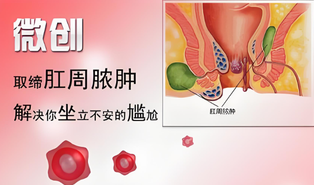 zui常见的直肠肛管周围脓肿是