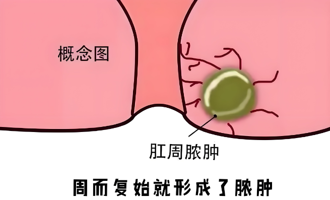 肛管直肠周围脓肿易形成