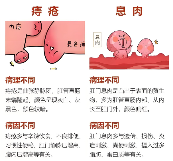 肛门息肉治疗后恢复周期需要多久