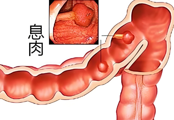 肛门息肉需要做手术吗