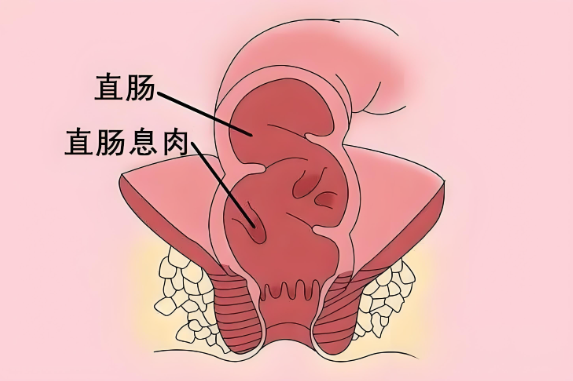肛乳头瘤治疗好后会复发吗？能维持多久