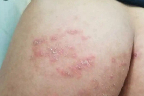 哪些人不能做肛门湿疹手术