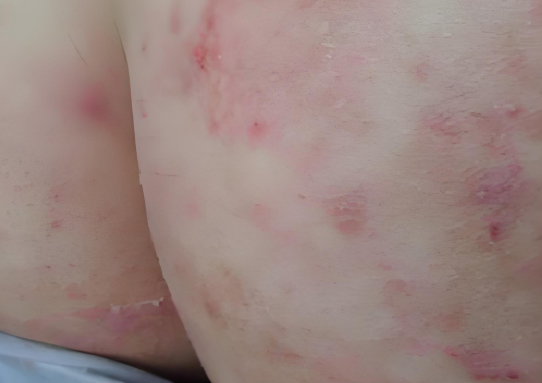 肛门湿疹采用什么设备