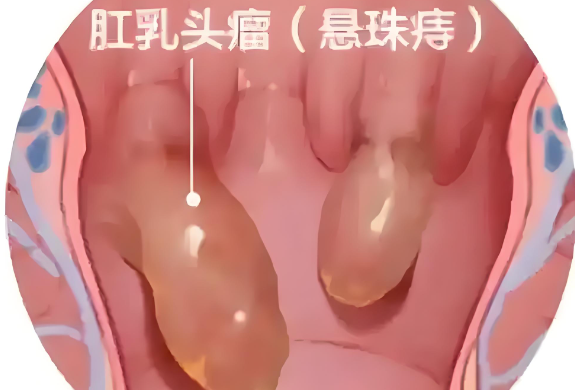 肛乳头瘤手术方法介绍