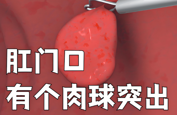 肛乳头瘤手术后多久时间恢复正常