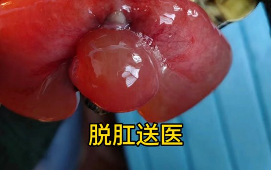 脱肛手术风险并发症