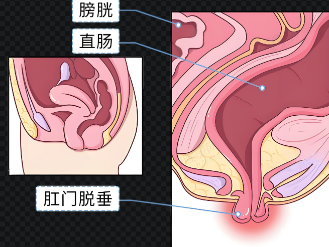 哪些人需要做脱肛手术