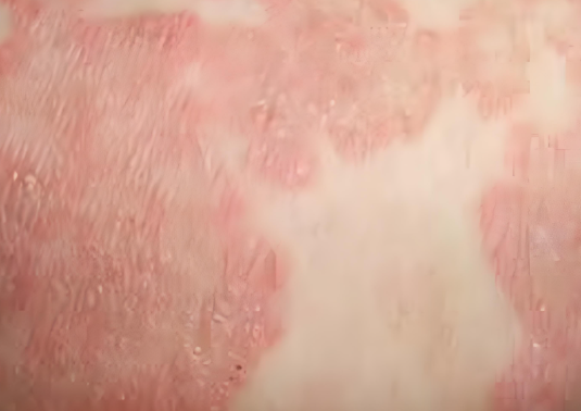 肛门湿疹的症状