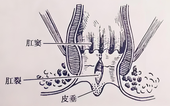 肛裂适用人群
