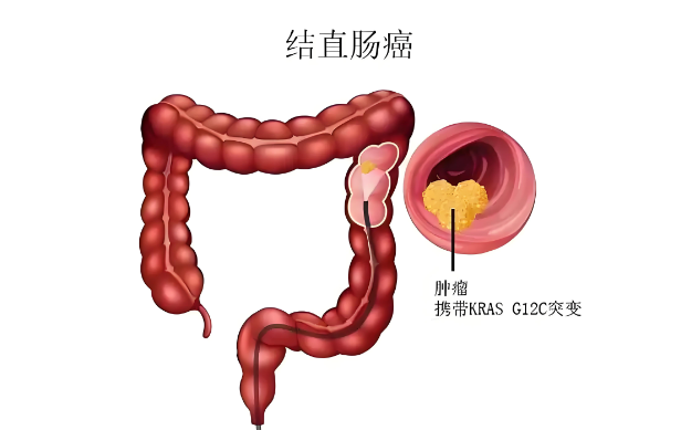小肠癌的早期症状