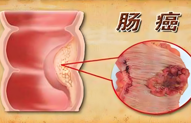 肠炎与肠癌zui明显区别