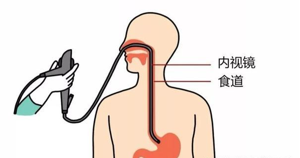 胃镜检查如何诊断胃炎？