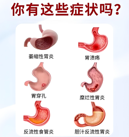 长期压力会引发胃病吗？