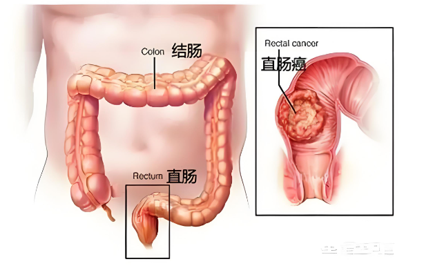肠炎会导致肠出血吗？