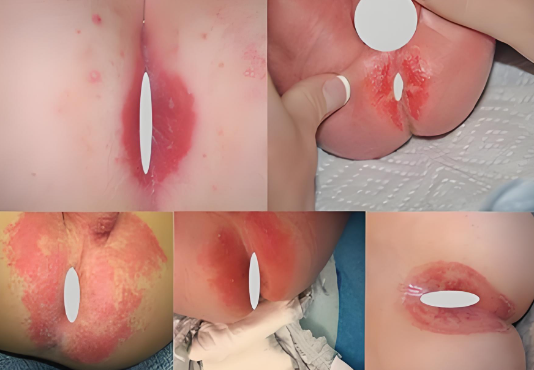 肛门湿疹的病程发展是怎样的？