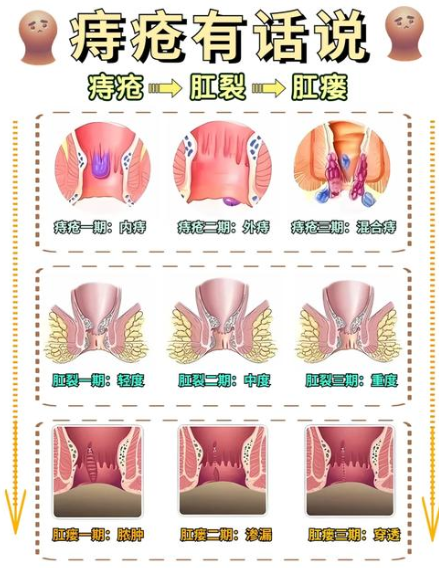 痔疮与直肠癌有关吗？
