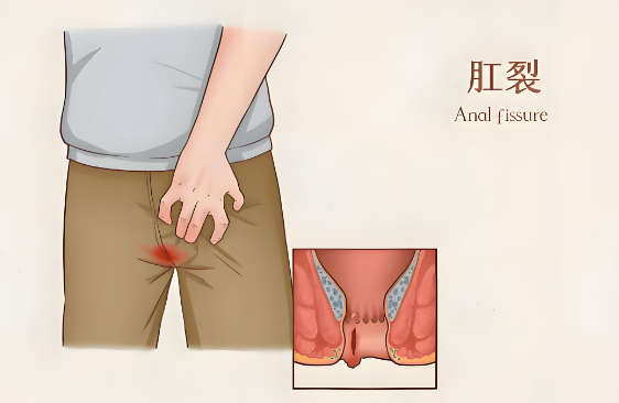 肛裂患者能参加社交活动吗？