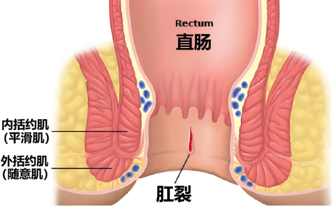 肛裂的常用药物有哪些？