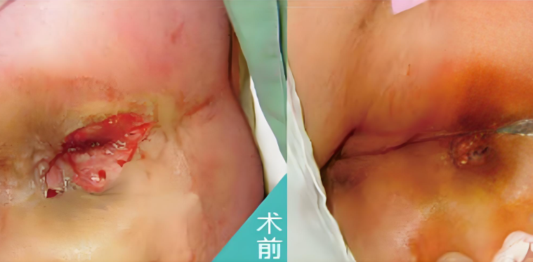 肛裂好发于哪些人群？