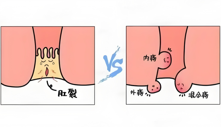 肛裂的疼痛有什么特点？
