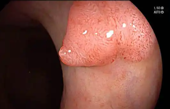 肛乳头瘤会引起肛门肿痛吗？