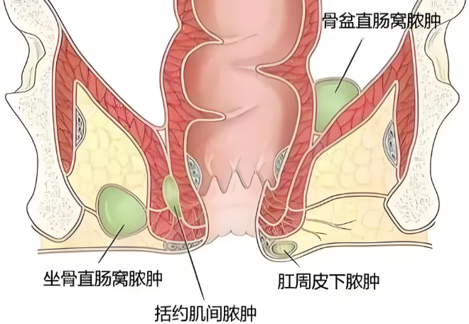 肛周脓肿会引起发烧吗？
