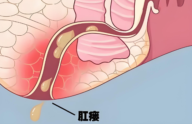 肛瘘手术后多久可以正常工作？