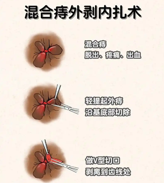 痔疮的中医治疗有哪些？
