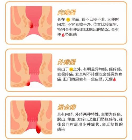 痔疮与年龄的关系是怎样的？