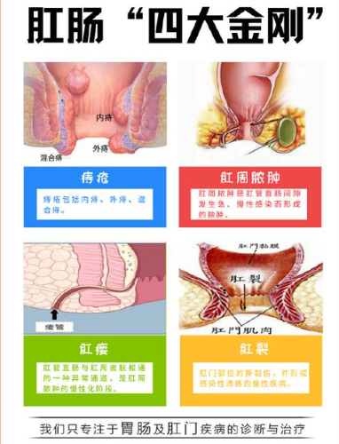 痔疮的手术治疗有哪些？