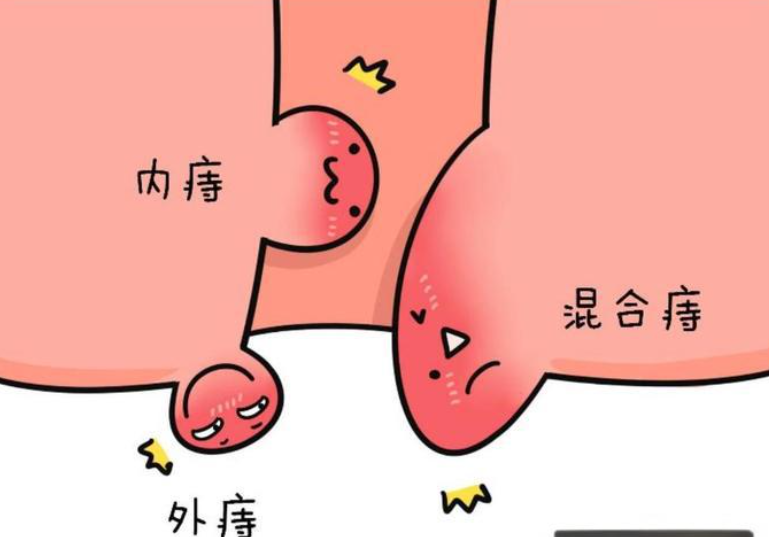 痔疮的高发人群是哪些？