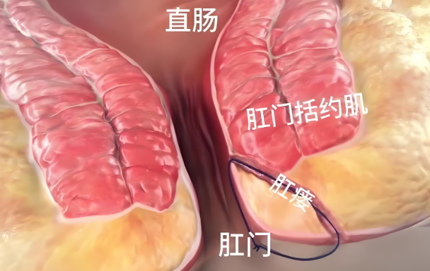 肛瘘患者日常如何清洁肛门？