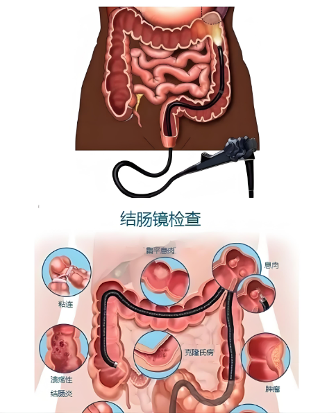 肠镜检查对肠道息肉的处理有何意义？