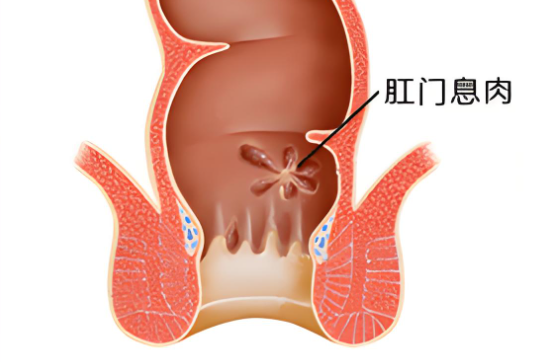 如何早期发现肛门息肉的癌变倾向？
